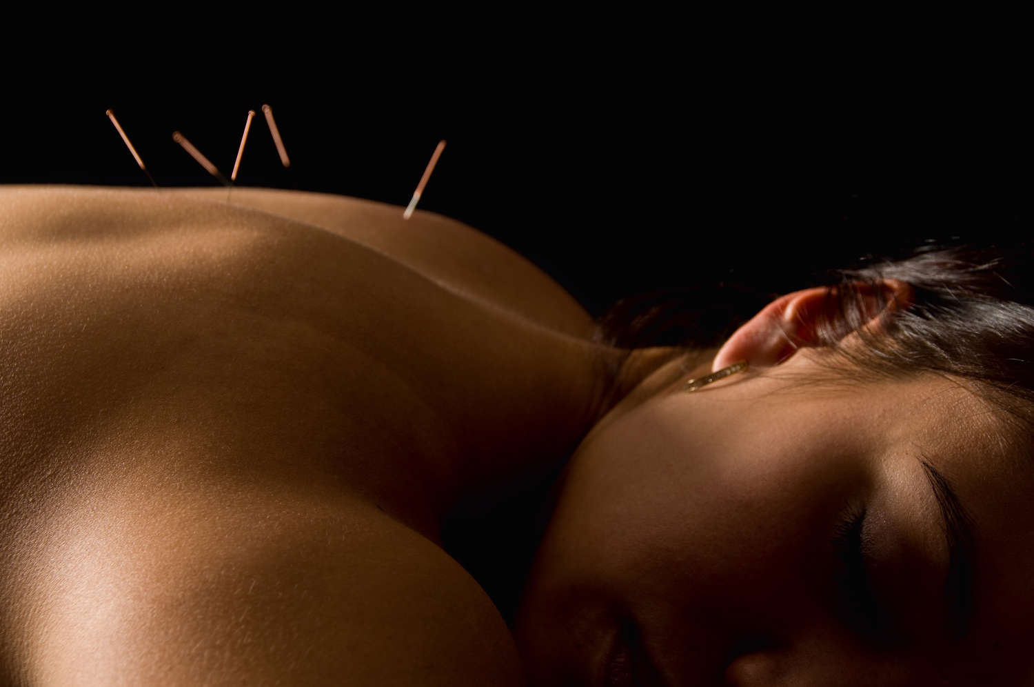 acupuncture-therapy